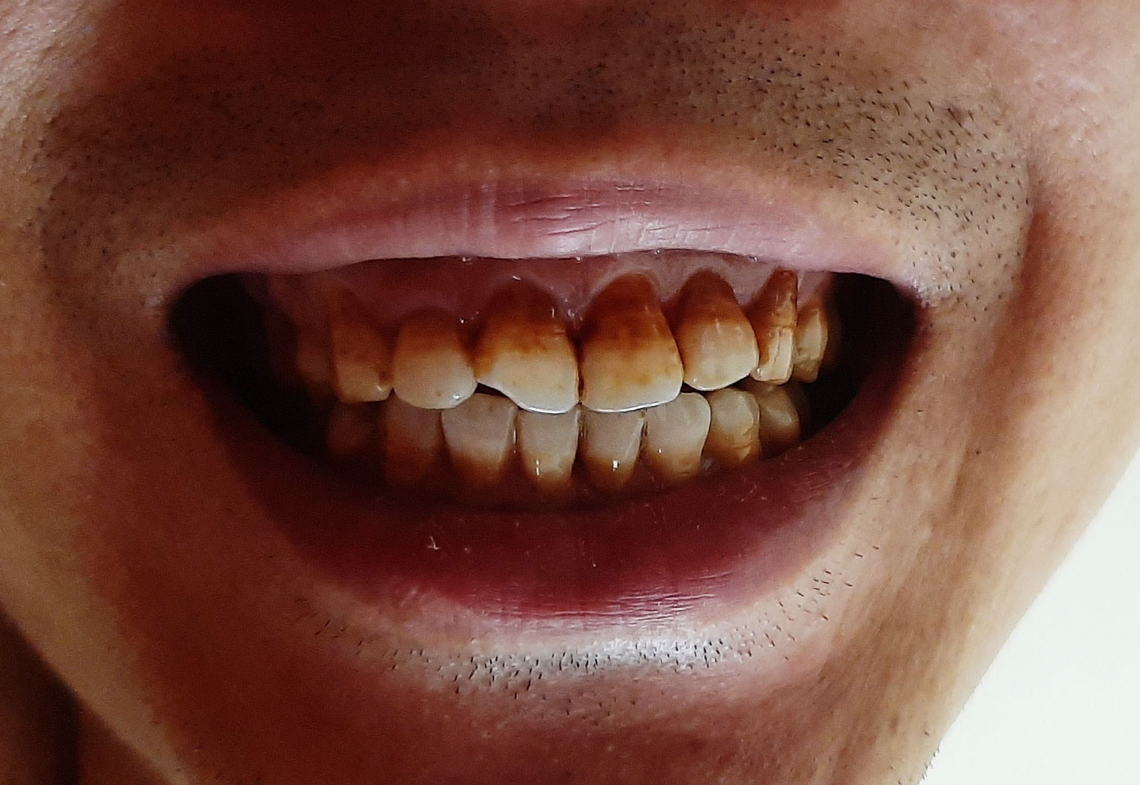 Hút thuốc lá gây ố vàng răng và nhiều bệnh lý khác về răng miệng ảnh hưởng đến sức khỏe