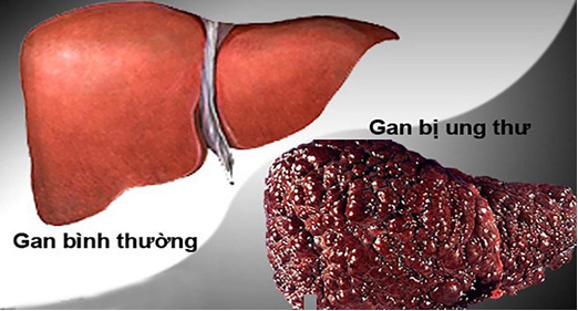 Hình ảnh ung thư gan (nguồn Internet)