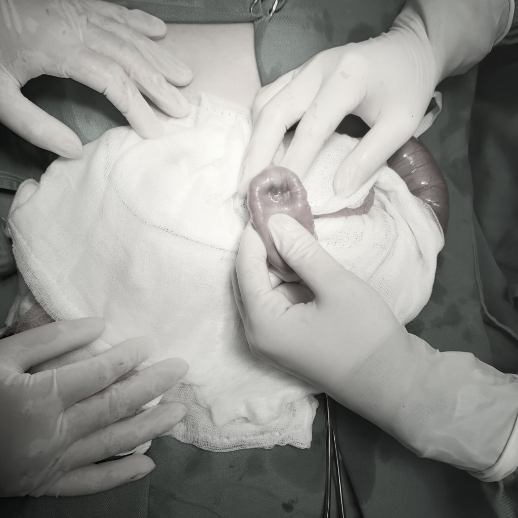 Phẫu thuật thành công cho người bệnh bị lồng ruột do u ruột non
