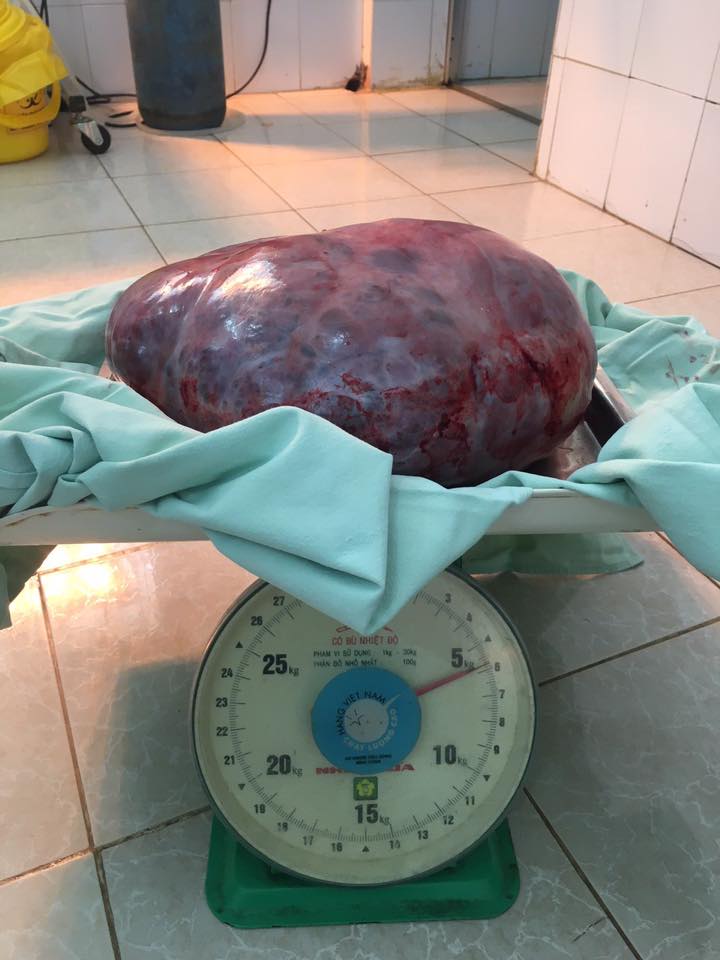 Khối u nặng gần 6kg được BVĐK huyện Đồng Văn phẫu thuật thành công 