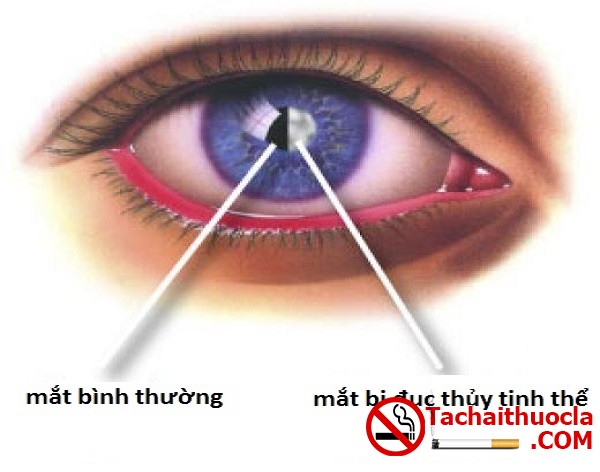 Hút thuốc lá gây nên các bệnh về mắt (ảnh nguồn internet)