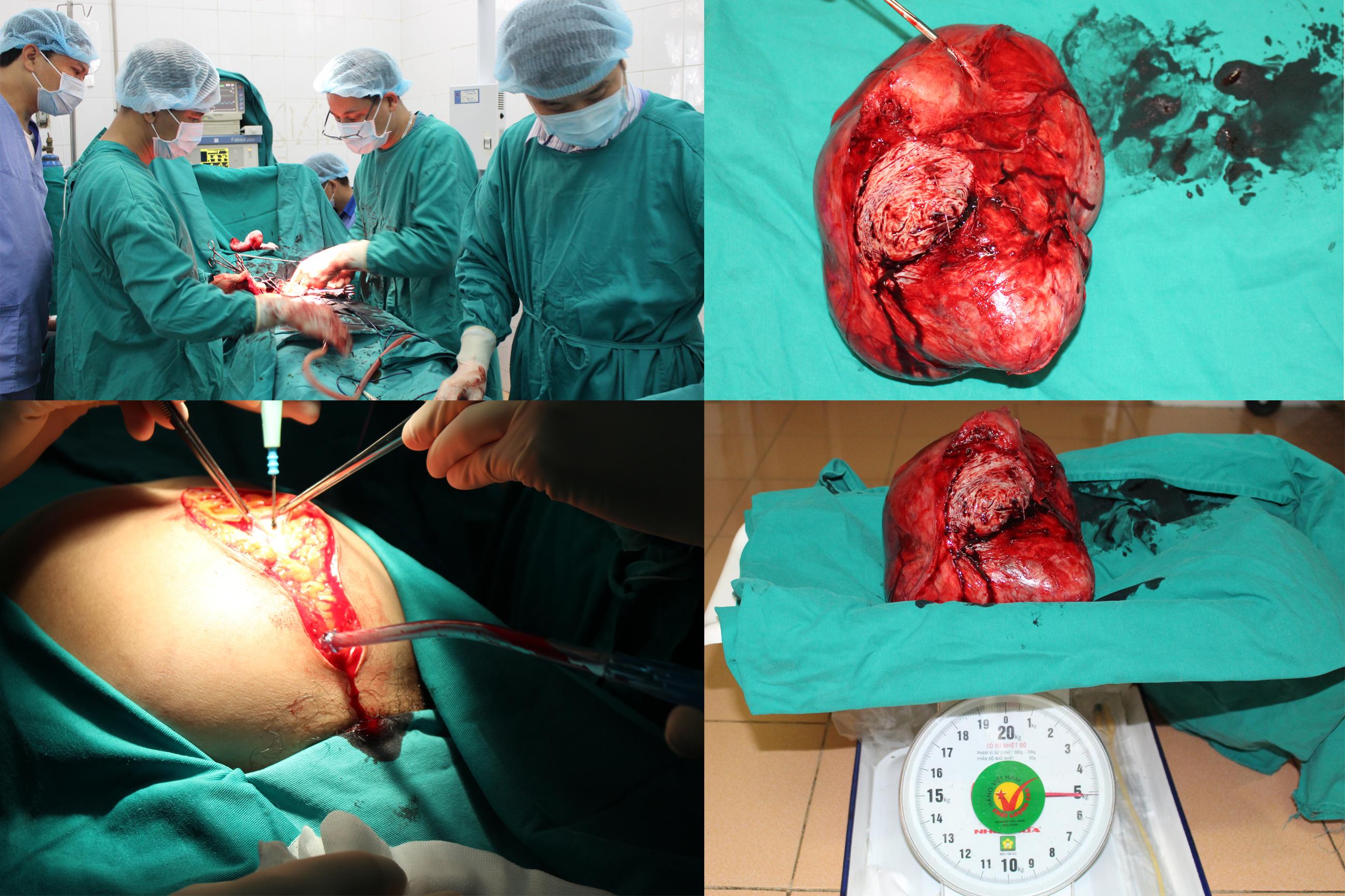 Bệnh viện ĐKKV Hoàng Su Phì phẫu thuật thành công u xơ nặng 5,3kg