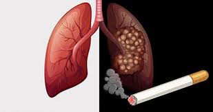 Hút thuốc lá gây tổn thương phổi (St)