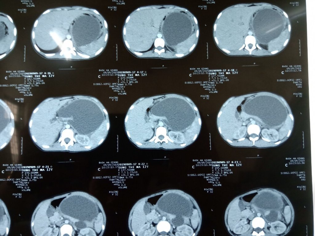 Hình ảnh chụp CT ổ bụng nang thân đuôi tụy của người bệnh Sùng Thị M.