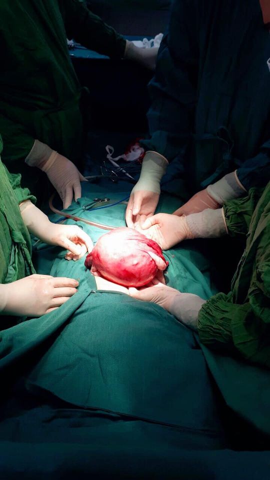Bệnh viện đa khoa khu vực huyện Bắc Quang phẫu thuật thành công khối u xơ tử cung nặng hơn 3kg