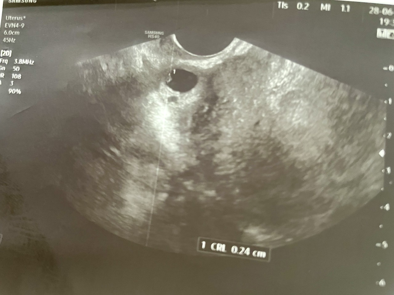 Hình ảnh siêu âm 4D đầu dò âm đạo: Vị trí khối thai tại vết sẹo mổ cũ.